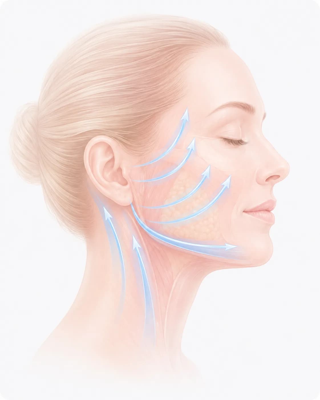 Face Lift